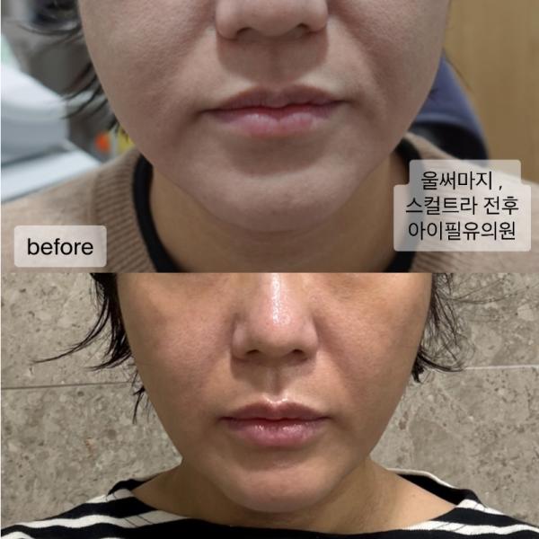 40대 중반 , 울쎄라 600 샷 후, 써마지 +스컬트라 전/후