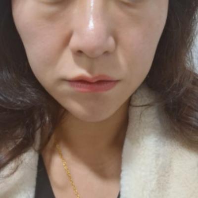 40대 이상, 실리프팅 , 아쉬운 후기 , 필요한 시술 뭐가 있을까