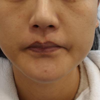 울쎄라 300샷 + 덴서티 300샷 효과, 주의 점, 아이필유의원 강남